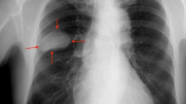 Radiografía de un cáncer de pulmón